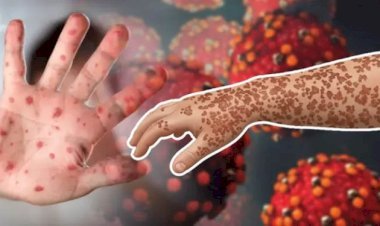 সিলেটে হামে আক্রান্ত হয়ে আরও এক শিশুর মৃত্যু