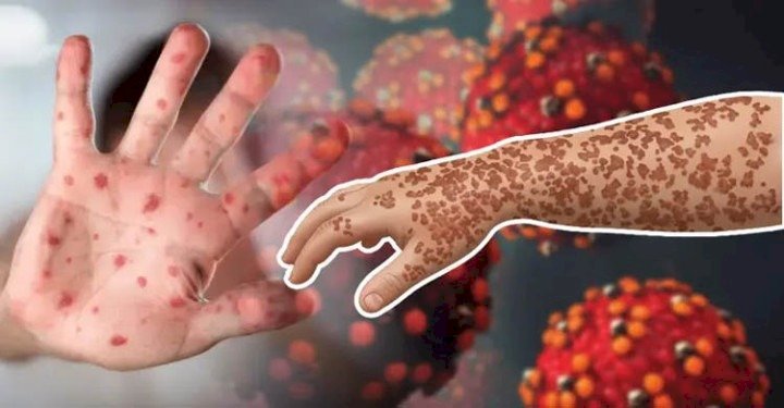 সিলেটে হামে আক্রান্ত হয়ে আরও এক শিশুর মৃত্যু