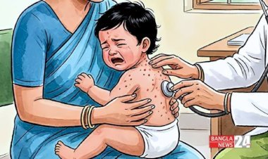 ২৪ ঘণ্টায় হাম ও উপসর্গে ১৭ জনের মৃত্যু