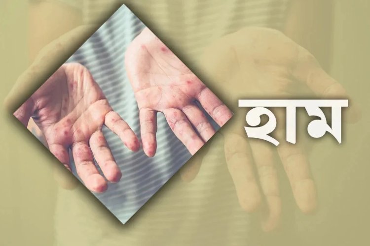২৪ ঘণ্টায় হাম ও উপসর্গে আরও ১২ জনের মৃত্যু